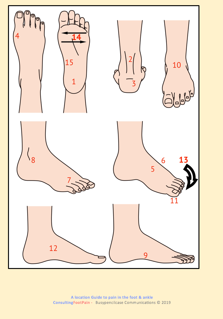 Plantar Fasciitis and the foot arch | Consulting Footpain