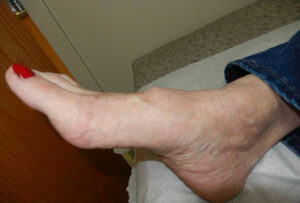 bone spur on top of foot images