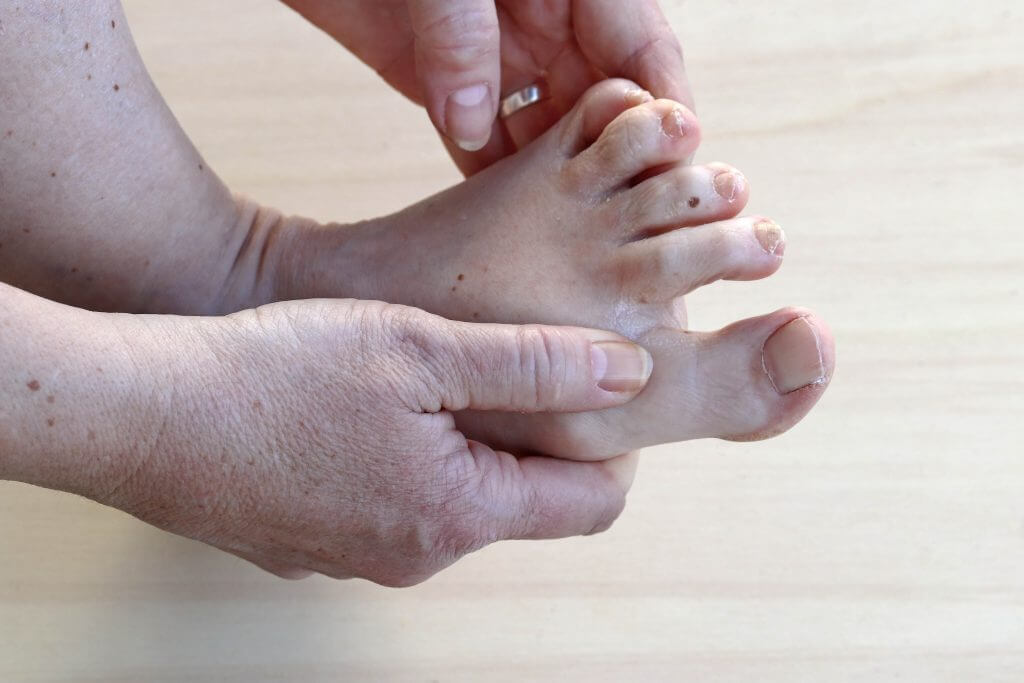 What Causes Hard Dry Skin On Toes