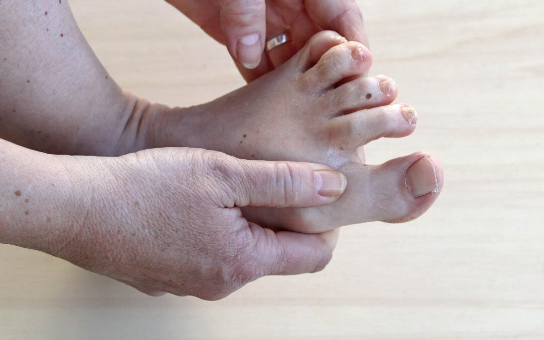 Dry Skin in the Foot Associated with Cancer Treatment