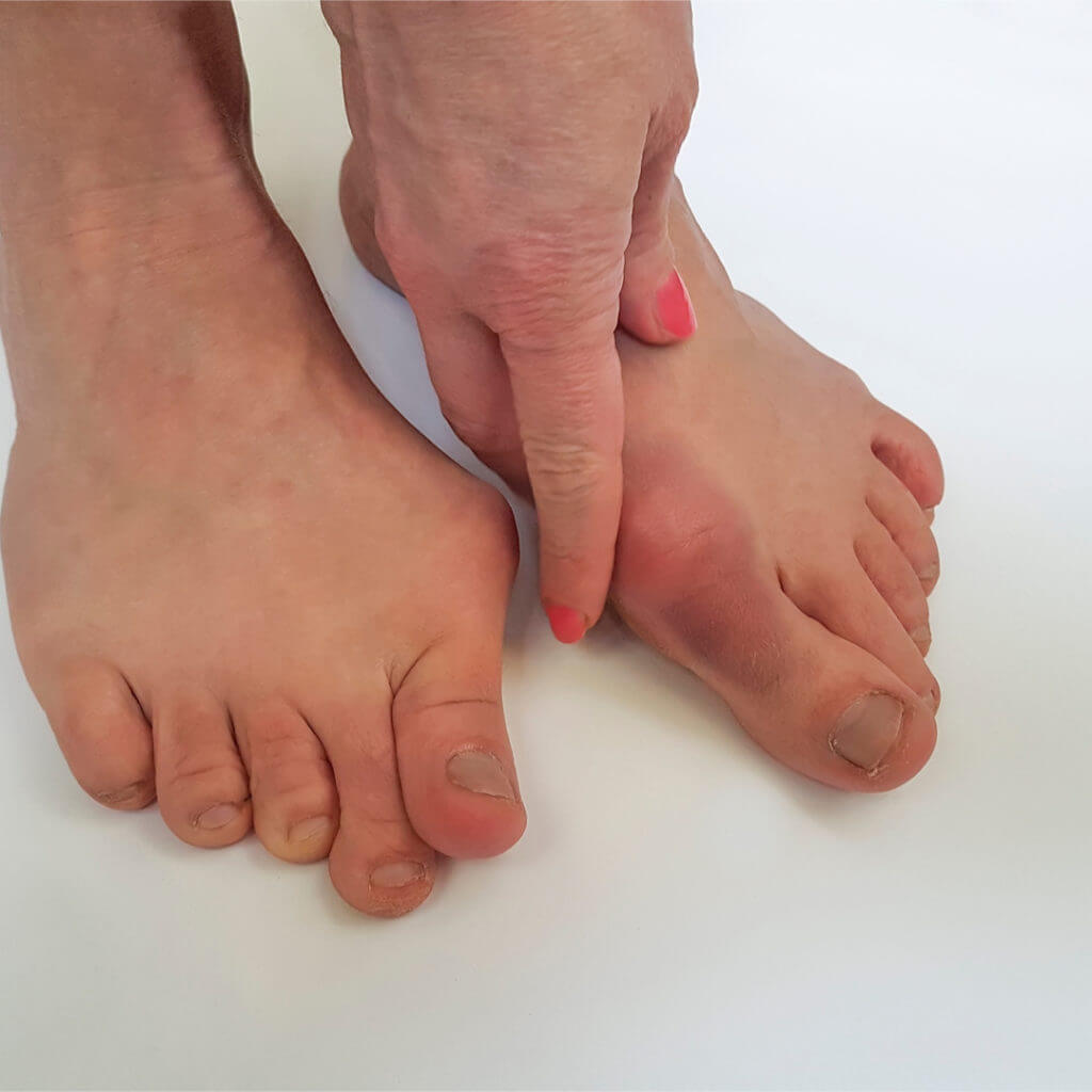 Hallux Valgus | Consulting Footpain