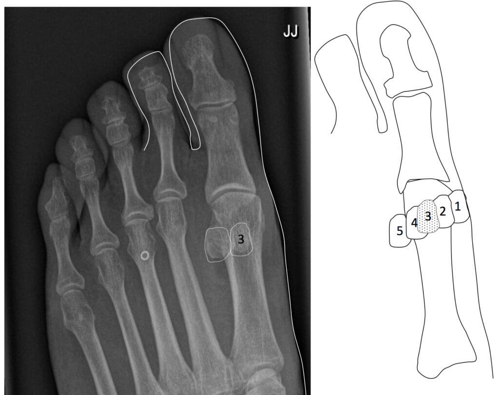 The Sesamoid Bone - Consulting Footpain