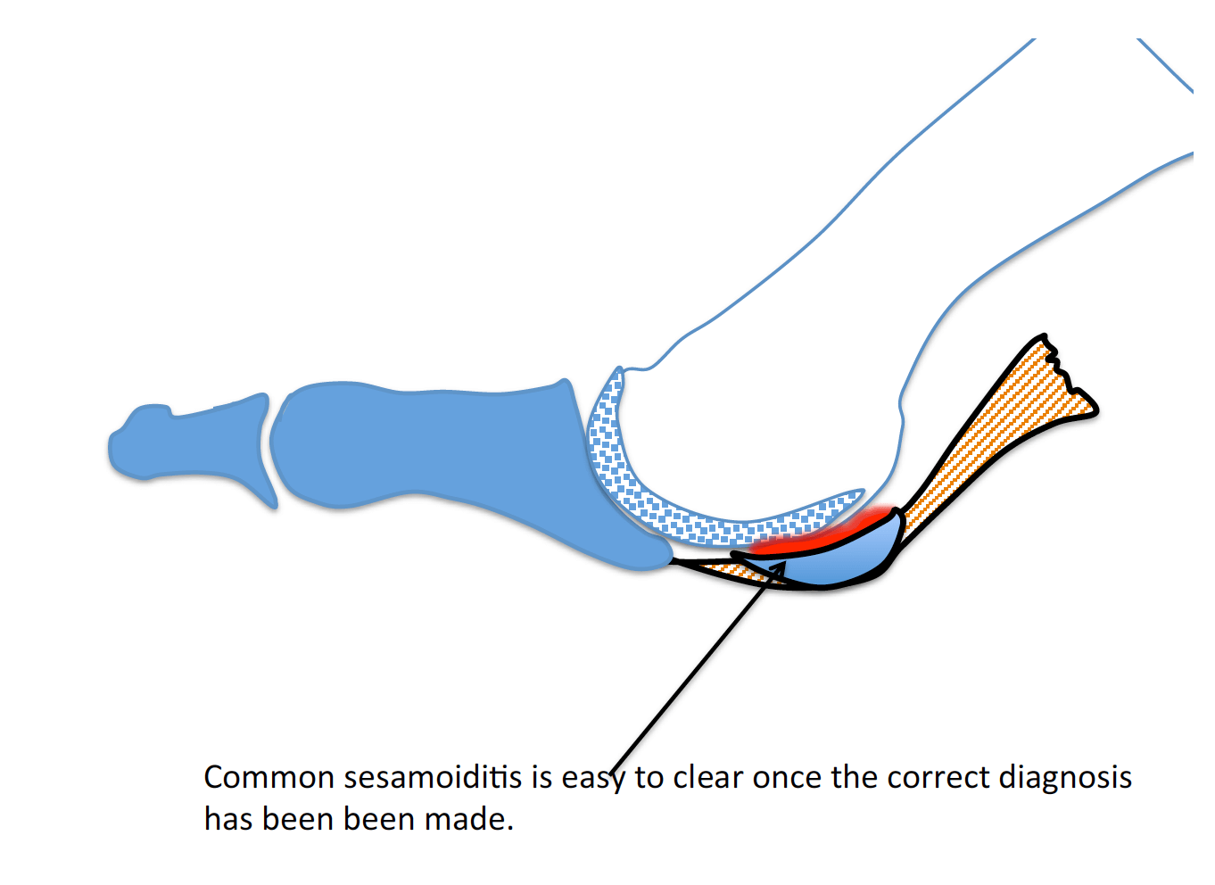 the-sesamoid-bone-consulting-footpain