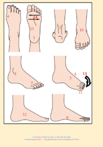 Plantar fasciitis - NHS