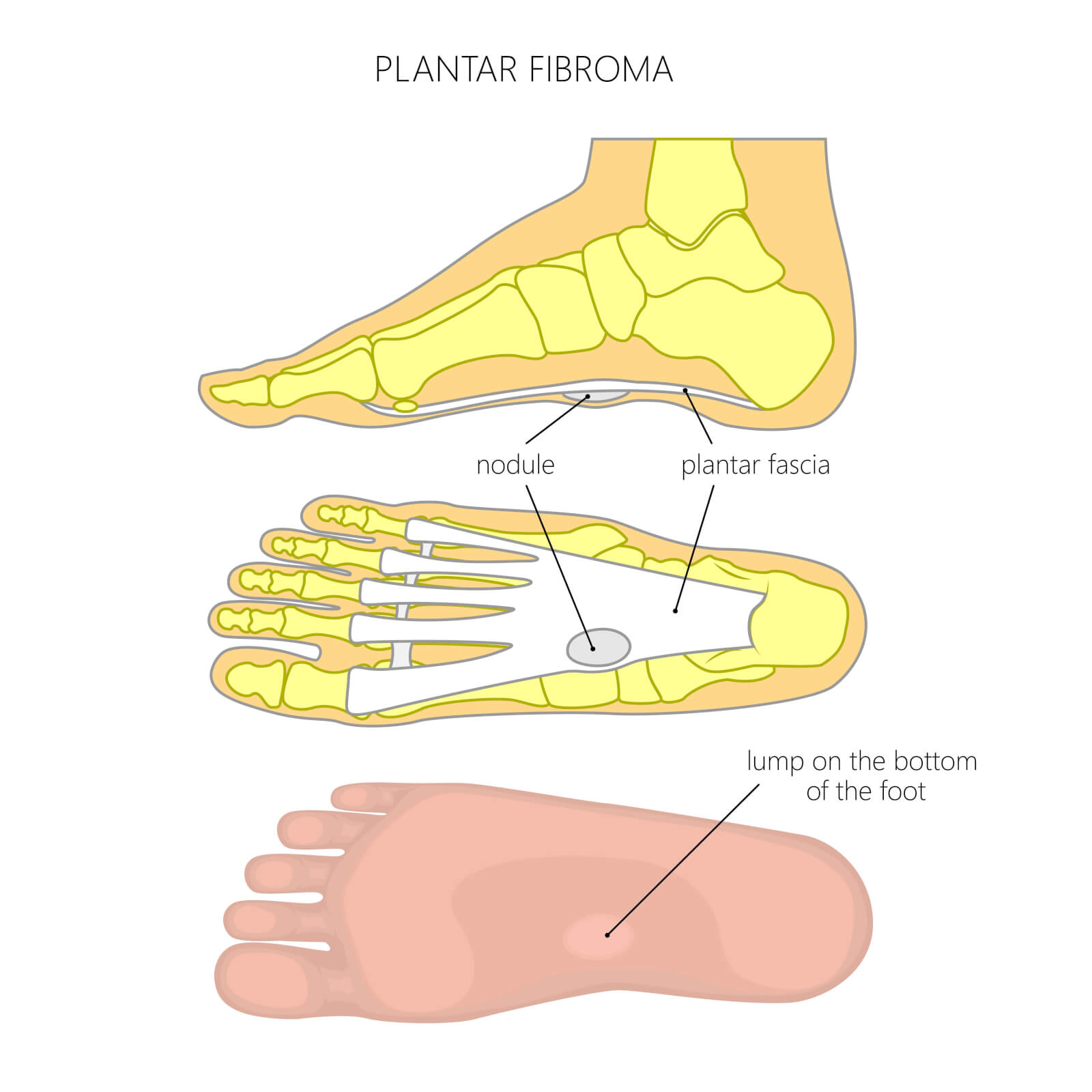 Plantar Fasciitis and the foot arch - Consulting Footpain