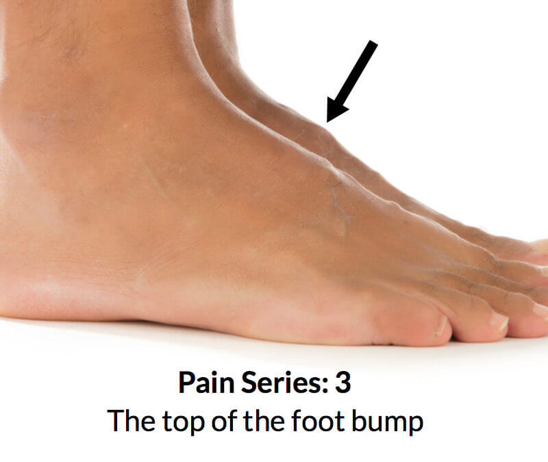 Foot Bump On Top Of The Foot Consulting Footpain