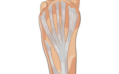 Plantar Fasciitis and Surgery