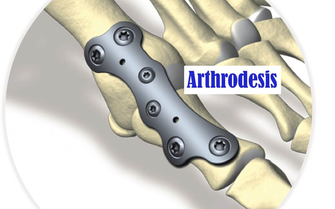 Arthrodesis definition & procedure