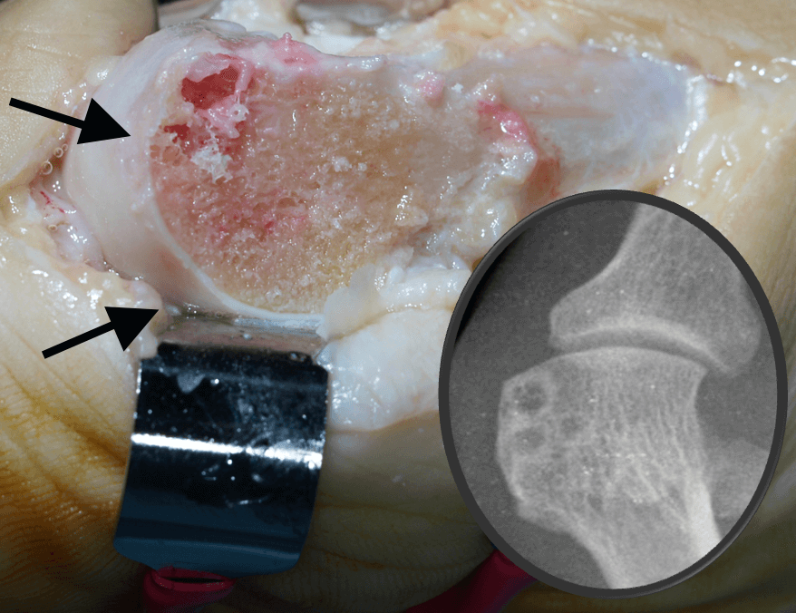 Cartilage damage in hallux valgus
