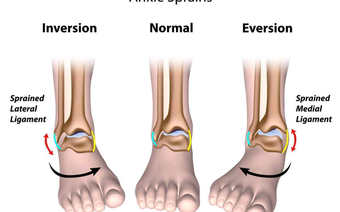 Ankle Sprains and Strains
