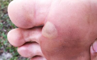 Pain and prevention of blisters