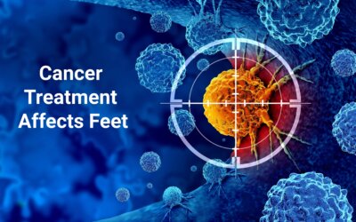 Five conditions in feet caused by cancer treatment