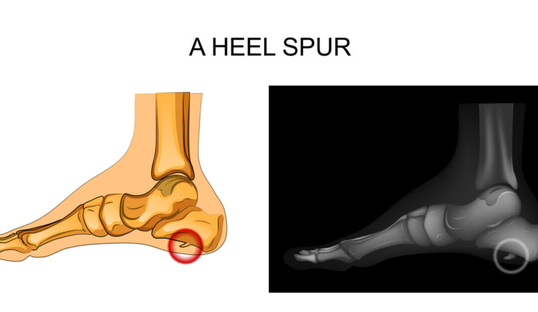 The Heel Spur myth
