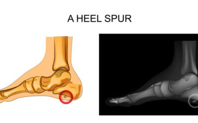 The Heel Spur myth