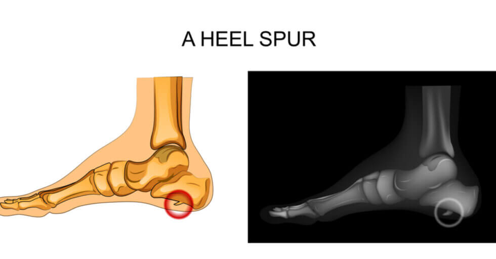 Heel Spur In Spanish Translation