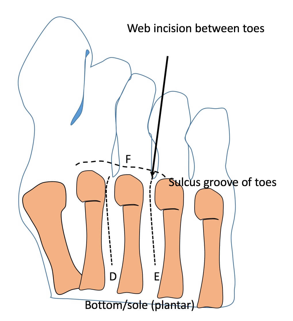 Incisional Surgery for Morton’s Neuroma - Consulting Footpain