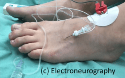 Management pathways for Morton’s Neuroma