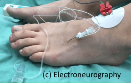 Management pathways for Morton’s Neuroma