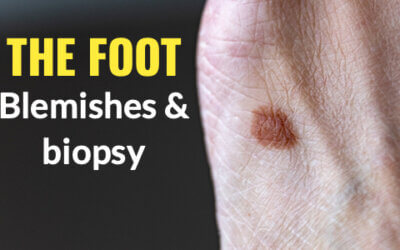 Biopsy in the foot