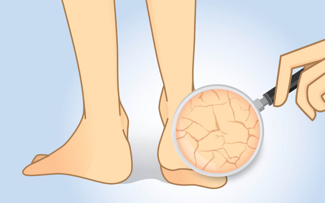 Skin Cracks & Fissures in Feet
