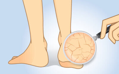 Skin Cracks & Fissures in Feet