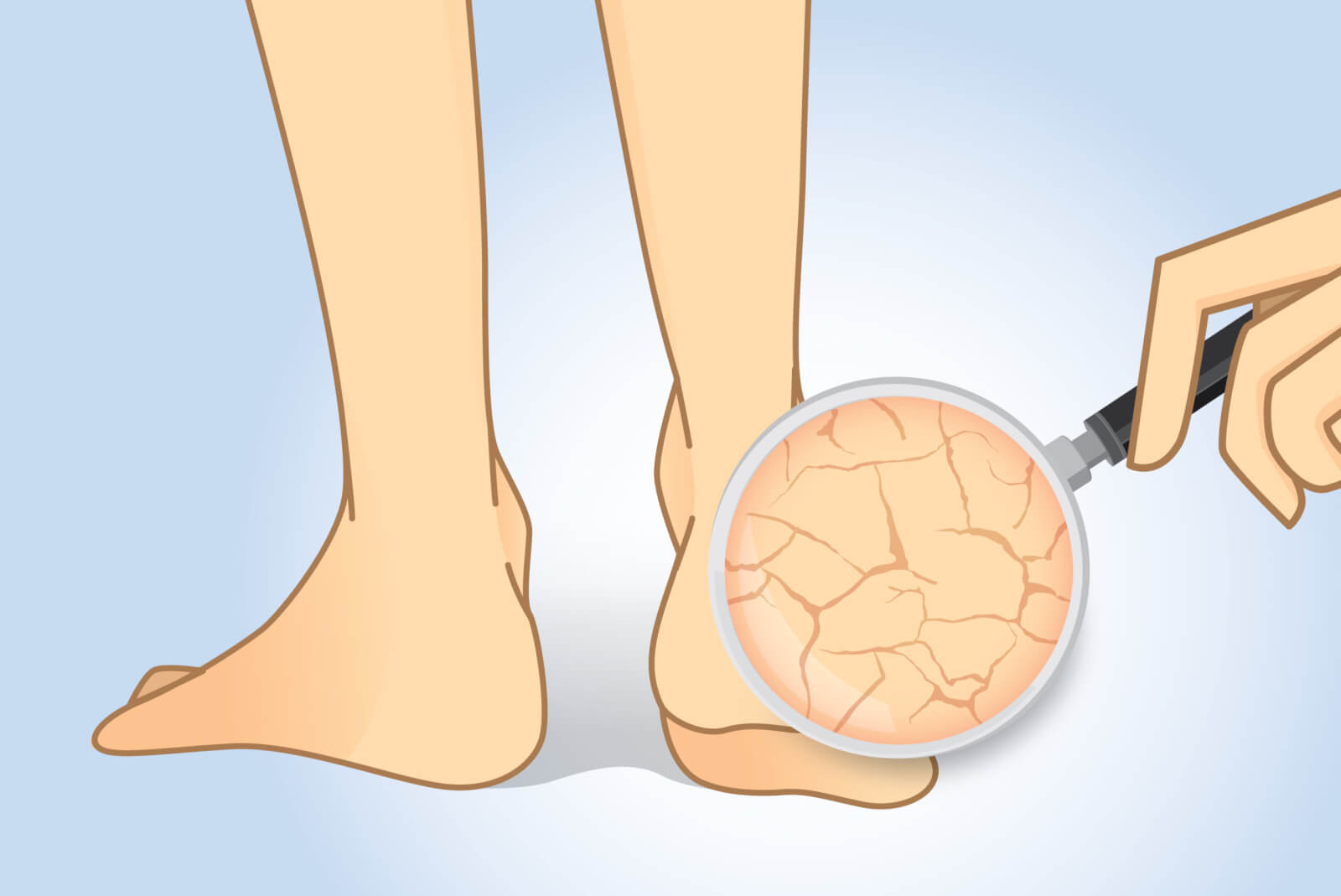 Cracked Heels: Treatment at Home | Health and Care