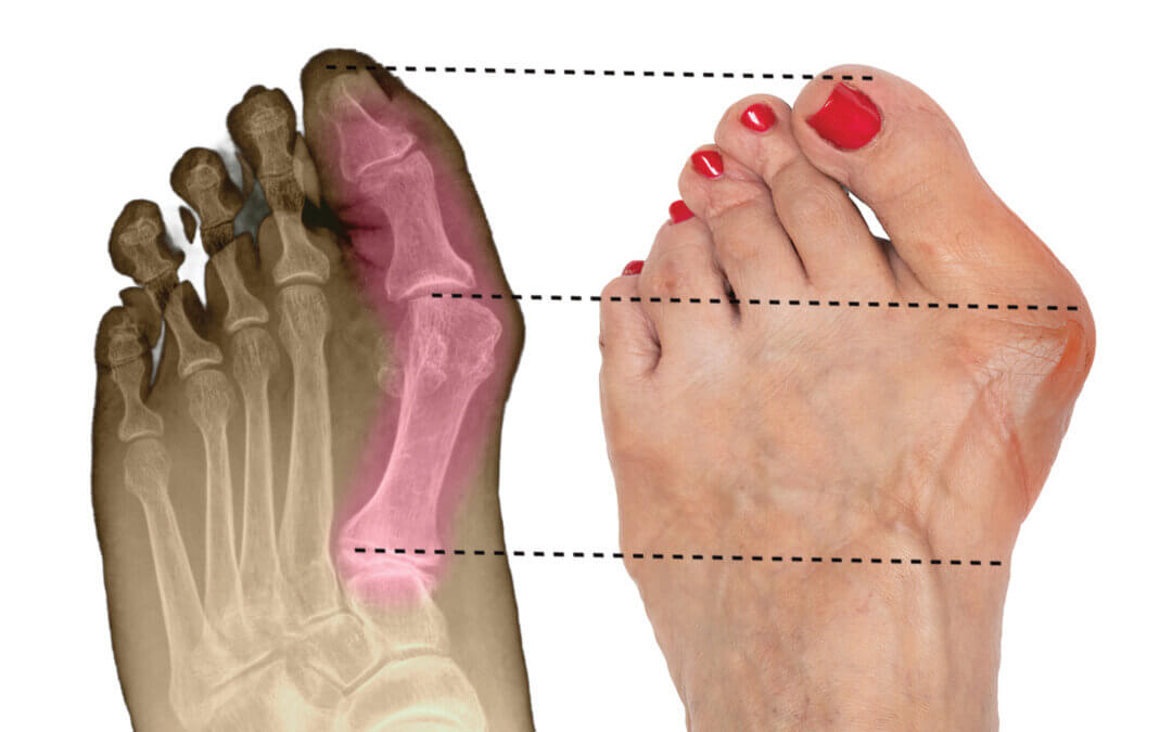 New Bunion Guide for Patients