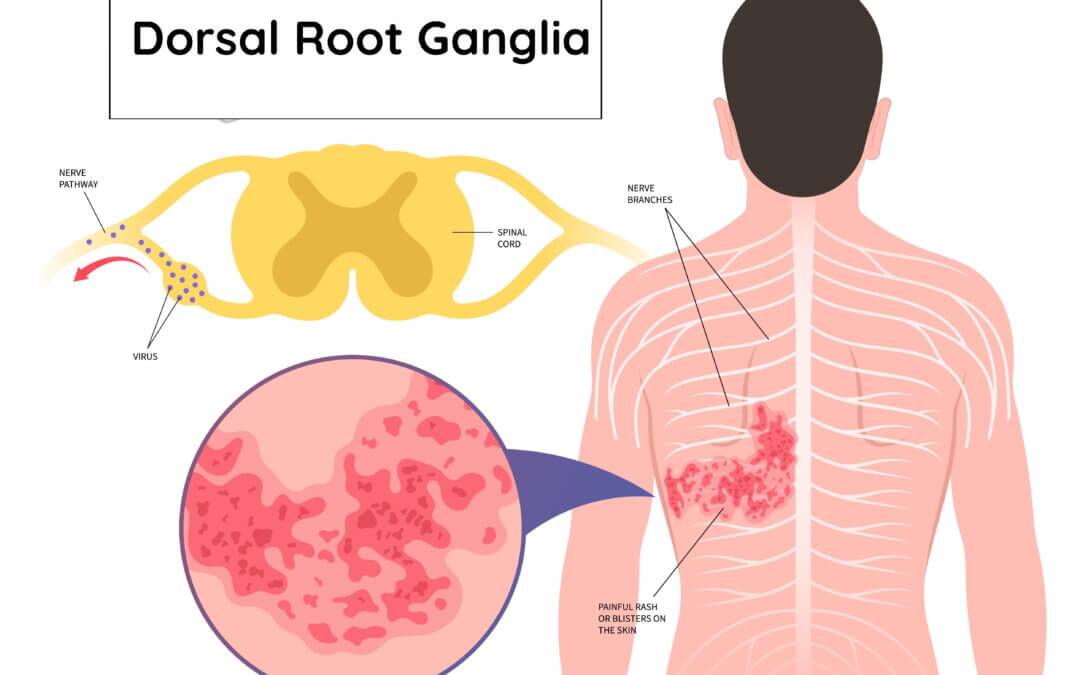 Pain and the Dorsal Root Ganglia