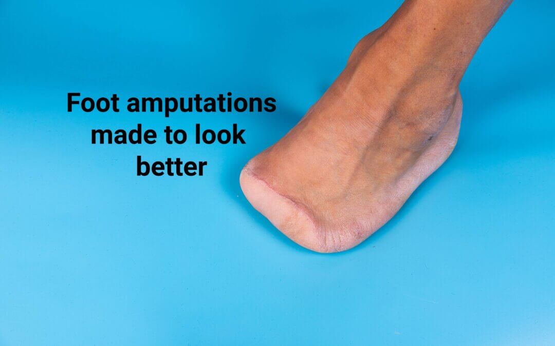 Your Foot After Amputation